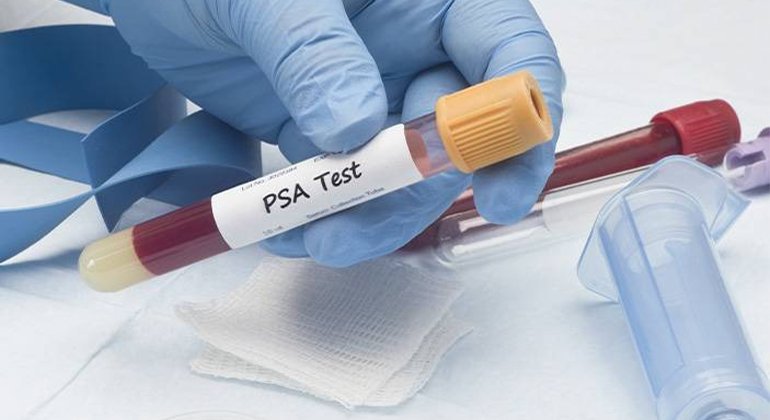 New urine test may help some men with elevated PSA avoid a biopsy