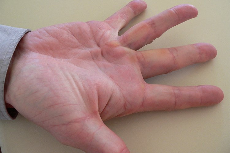 Dupuytren's Contracture of the Hand