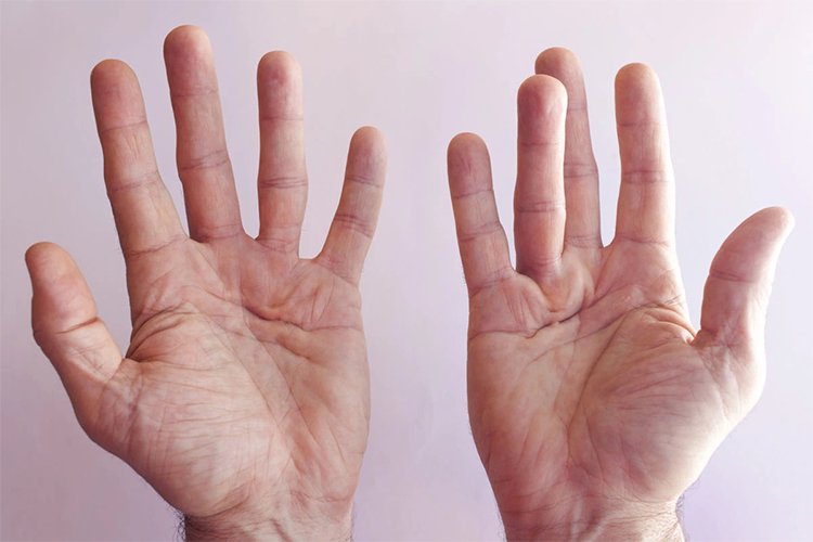 Dupuytren's Contracture of the Hand