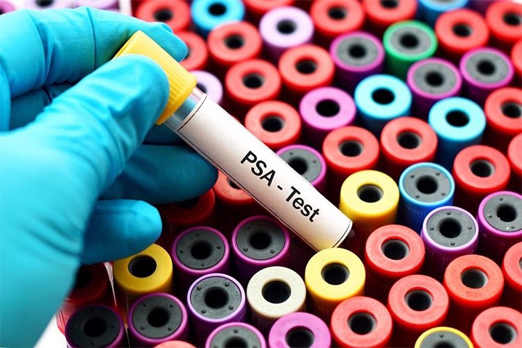 New urine test may help some men with elevated PSA avoid a biopsy