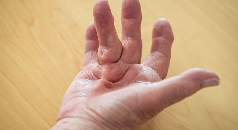 Dupuytren's Contracture of the Hand
